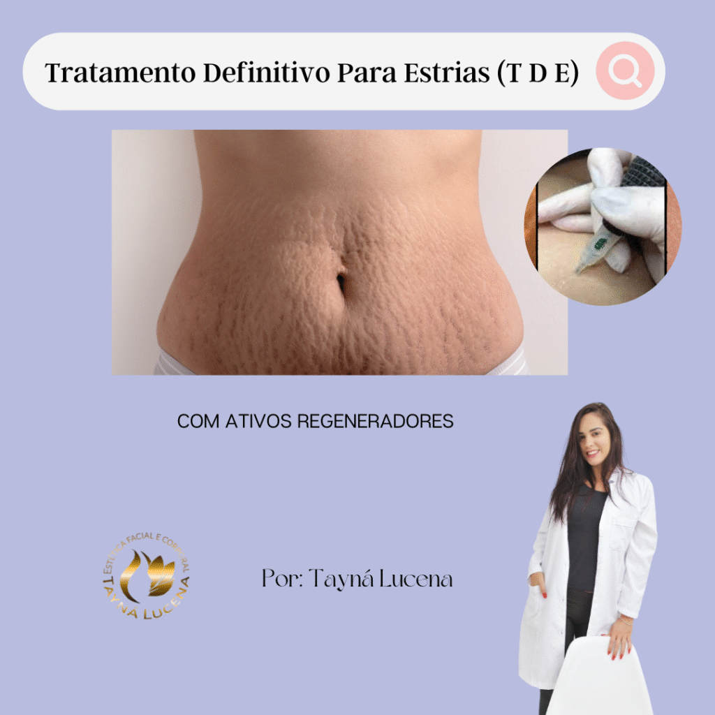 Curso Tratamento Definitivo Para Estrias de Tayna de Lucena Silva: O Guia Completo para Tratamentos e Resultados Qual o Melhor Curso